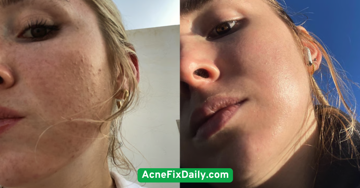 Avoid heavy or pore-clogging makeup