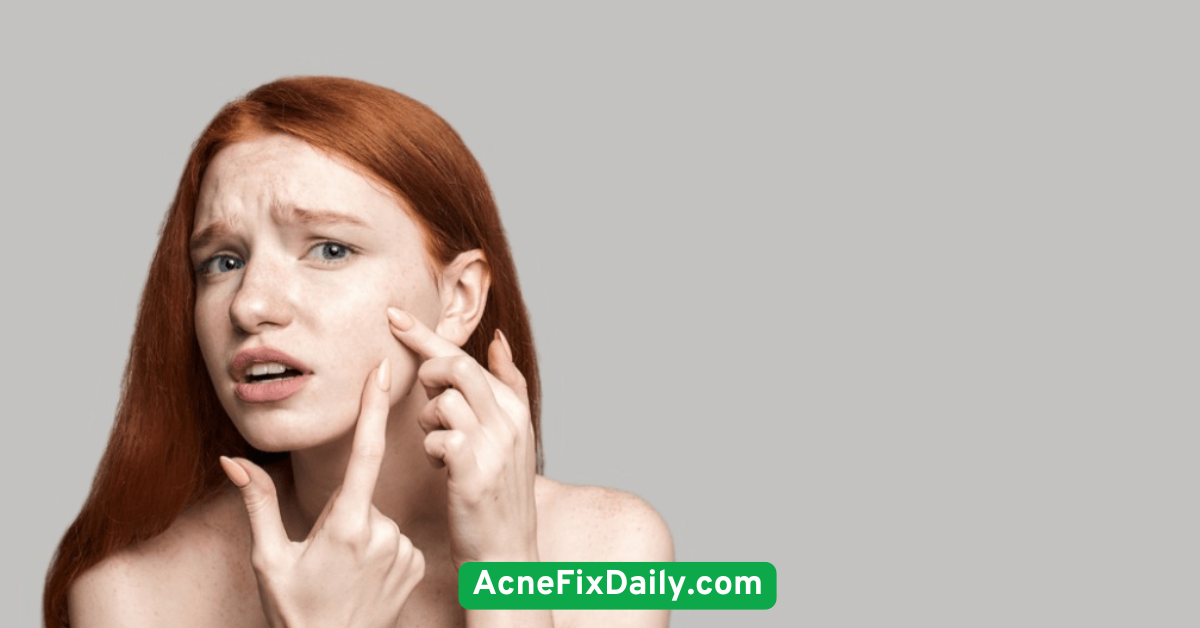  Don’t Pick or Pop Pimples