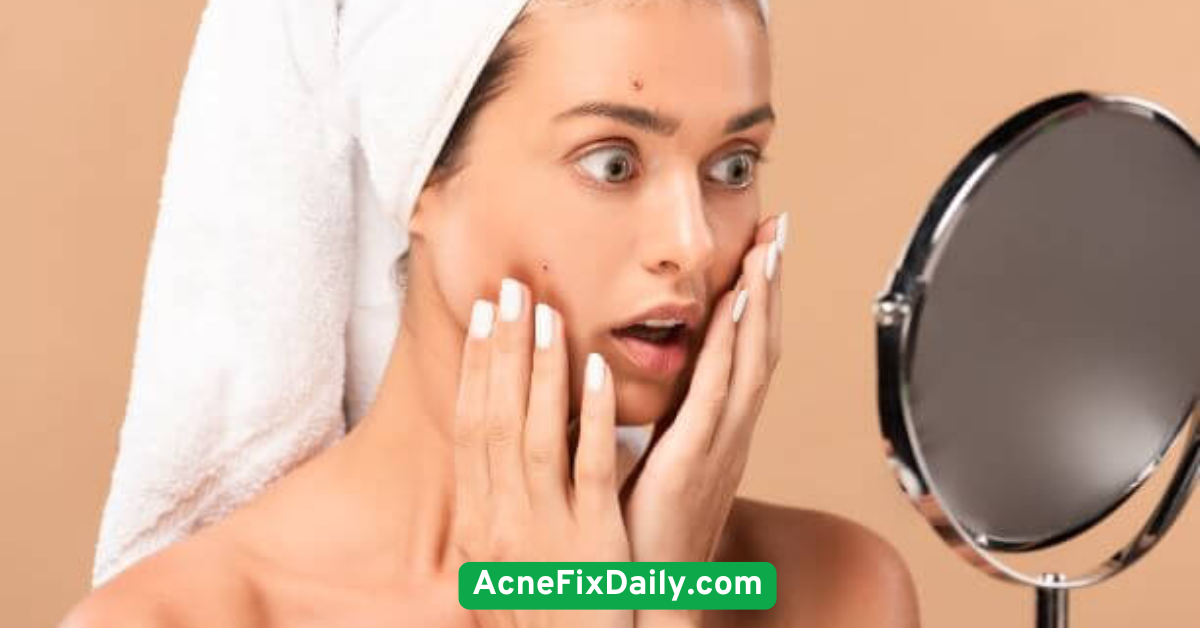 Manage Stress to Prevent Breakouts and Excess Oil