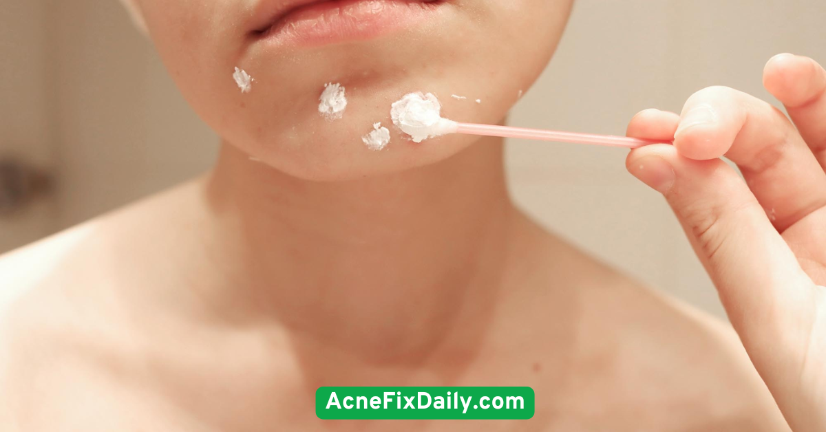 Spot Treat with Benzoyl Peroxide